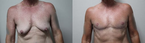 female to male transition before and after photos by kryger institute of plastic surgery in thousand oaks ca