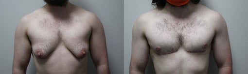 female to male transition before and after photos by kryger institute of plastic surgery in thousand oaks ca