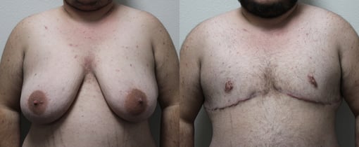 female to male transition before and after photos by kryger institute of plastic surgery in thousand oaks ca