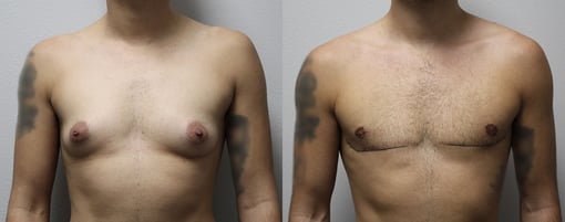 female to male transition before and after photos by kryger institute of plastic surgery in thousand oaks ca