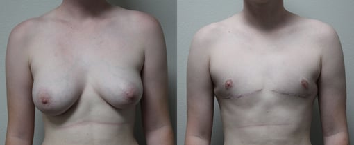 female to male transition before and after photos by kryger institute of plastic surgery in thousand oaks ca