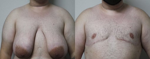 female to male transition before and after photos by kryger institute of plastic surgery in thousand oaks ca