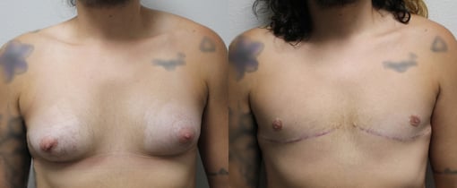 female to male transition before and after photos by kryger institute of plastic surgery in thousand oaks ca