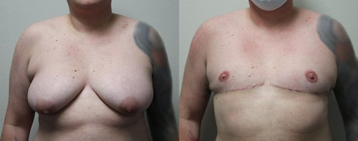 female to male transition before and after photos by kryger institute of plastic surgery in thousand oaks ca