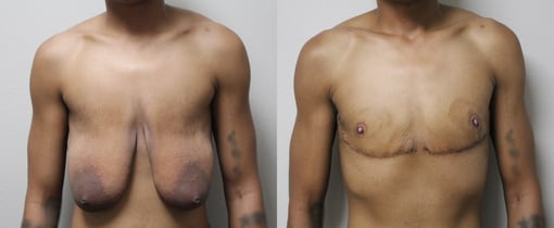 female to male transition before and after photos by kryger institute of plastic surgery in thousand oaks ca