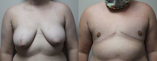 female to male transition before and after photos by kryger institute of plastic surgery in thousand oaks ca