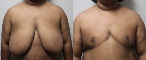 female to male transition before and after photos by kryger institute of plastic surgery in thousand oaks ca