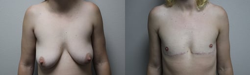 female to male transition before and after photos by kryger institute of plastic surgery in thousand oaks ca