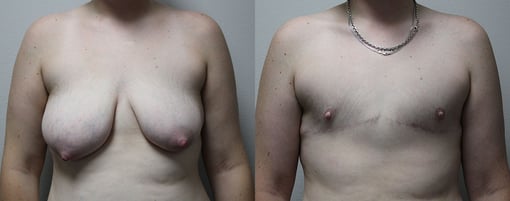 female to male transition before and after photos by kryger institute of plastic surgery in thousand oaks ca