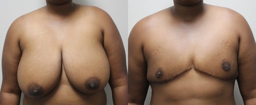 female to male transition before and after photos by kryger institute of plastic surgery in thousand oaks ca