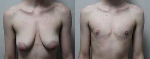 female to male transition before and after photos by kryger institute of plastic surgery in thousand oaks ca