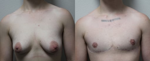 female to male transition before and after photos by kryger institute of plastic surgery in thousand oaks ca