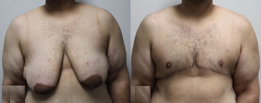 female to male transition before and after photos by kryger institute of plastic surgery in thousand oaks ca
