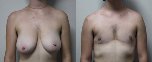 female to male transition before and after photos by kryger institute of plastic surgery in thousand oaks ca