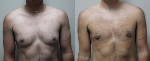 female to male transition before and after photos by kryger institute of plastic surgery in thousand oaks ca