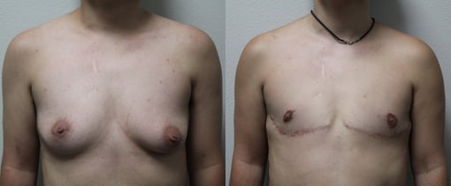 female to male transition before and after photos by kryger institute of plastic surgery in thousand oaks ca