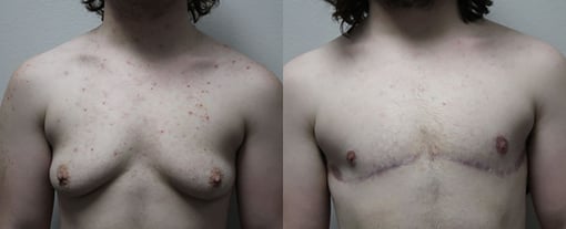 female to male transition before and after photos by kryger institute of plastic surgery in thousand oaks ca