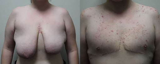 female to male transition before and after photos by kryger institute of plastic surgery in thousand oaks ca
