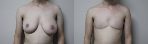 female to male transition before and after photos by kryger institute of plastic surgery in thousand oaks ca