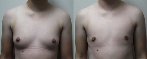 female to male transition before and after photos by kryger institute of plastic surgery in thousand oaks ca