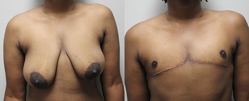 female to male transition before and after photos by kryger institute of plastic surgery in thousand oaks ca