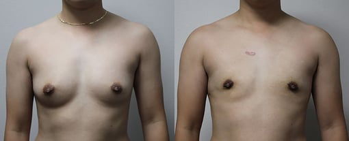 female to male transition before and after photos by kryger institute of plastic surgery in thousand oaks ca