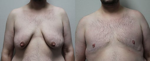 female to male transition before and after photos by kryger institute of plastic surgery in thousand oaks ca