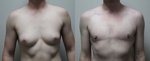 female to male transition before and after photos by kryger institute of plastic surgery in thousand oaks ca