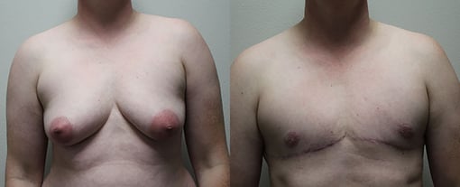 female to male transition before and after photos by kryger institute of plastic surgery in thousand oaks ca