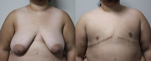 female to male transition before and after photos by kryger institute of plastic surgery in thousand oaks ca