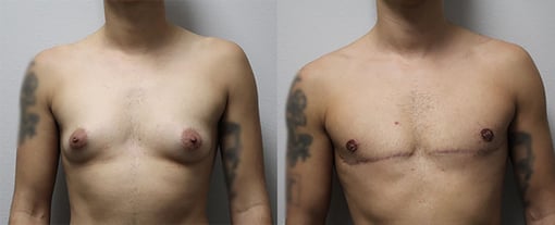 female to male transition before and after photos by kryger institute of plastic surgery in thousand oaks ca