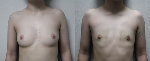 female to male transition before and after photos by kryger institute of plastic surgery in thousand oaks ca