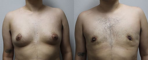 female to male transition before and after photos by kryger institute of plastic surgery in thousand oaks ca