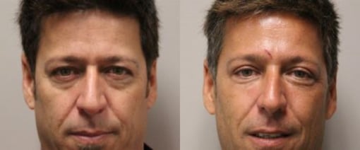 fat grafting before and after photos by kryger institute of plastic surgery in thousand oaks ca