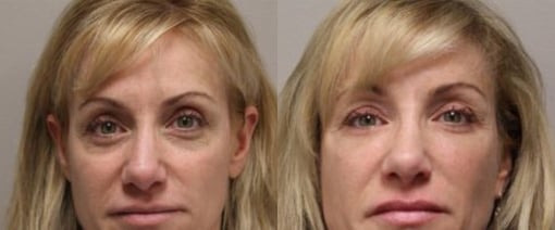 fat grafting before and after photos by kryger institute of plastic surgery in thousand oaks ca