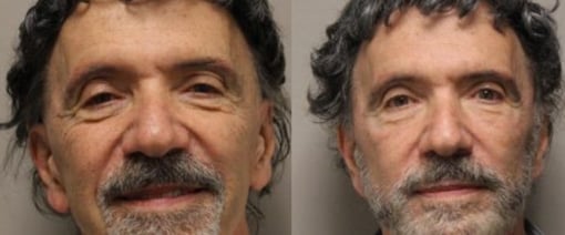 fat grafting before and after photos by kryger institute of plastic surgery in thousand oaks ca