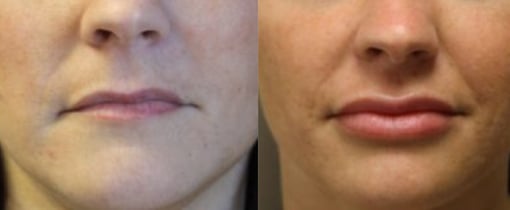 fat grafting before and after photos by kryger institute of plastic surgery in thousand oaks ca