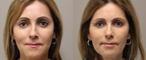 fat grafting before and after photos by kryger institute of plastic surgery in thousand oaks ca