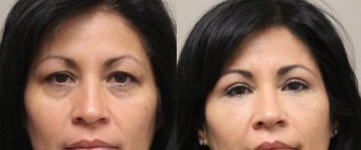 fat grafting before and after photos by kryger institute of plastic surgery in thousand oaks ca