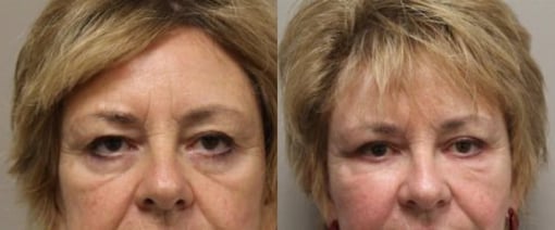 fat grafting before and after photos by kryger institute of plastic surgery in thousand oaks ca
