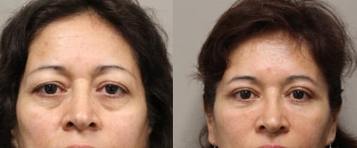 fat grafting before and after photos by kryger institute of plastic surgery in thousand oaks ca