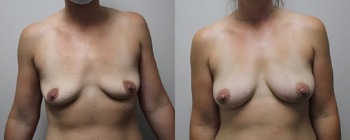 fat grafting breast before and after photos by kryger institute of plastic surgery in thousand oaks ca