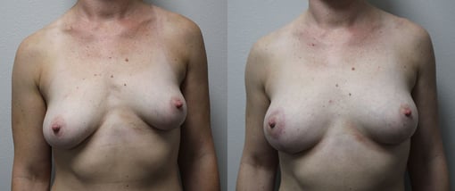 fat grafting breast before and after photos by kryger institute of plastic surgery in thousand oaks ca