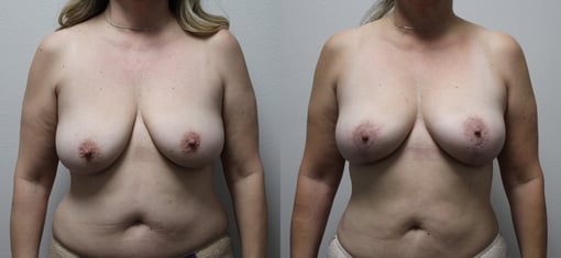 fat grafting breast before and after photos by kryger institute of plastic surgery in thousand oaks ca