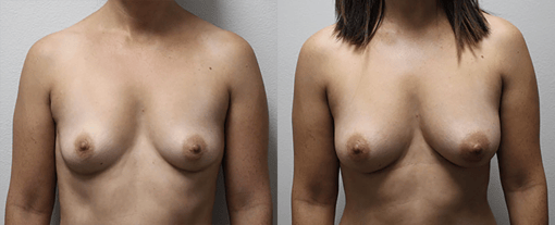fat grafting breast before and after photos by kryger institute of plastic surgery in thousand oaks ca