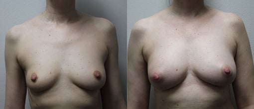 fat grafting breast before and after photos by kryger institute of plastic surgery in thousand oaks ca