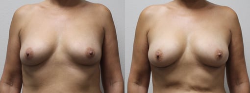 fat grafting breast before and after photos by kryger institute of plastic surgery in thousand oaks ca