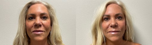 facelift necklift before and after photos by kryger institute of plastic surgery in thousand oaks ca