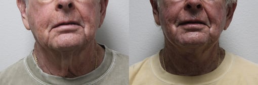 facelift necklift before and after photos by kryger institute of plastic surgery in thousand oaks ca