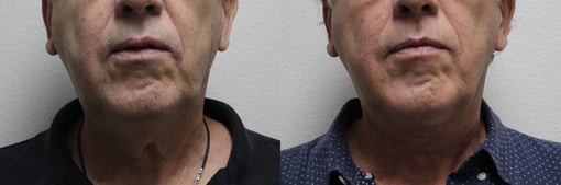 facelift necklift before and after photos by kryger institute of plastic surgery in thousand oaks ca